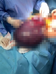 https://www.tp24.it/immagini_articoli/10-09-2026/all-ospedale-di-marsala-asportato-un-fibroma-dell-utero-di-16-chili-250.jpg
