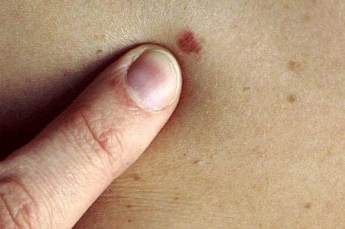 https://www.tp24.it/immagini_articoli/30-05-2025/1748618088-0-melanoma-in-sicilia-aumentano-i-casi-anche-tra-i-giovani.jpg