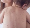 https://www.tp24.it/immagini_articoli/07-04-2018/1523079027-0-cataniaun-bambino-mesi-muore-morbillo-contagiato-madre-vaccinata.jpg