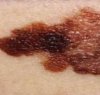 https://www.tp24.it/immagini_articoli/16-11-2011/1379491879-1-nuove-strategie-per-la-diagnosi-del-melanoma.jpg